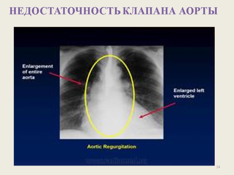 НЕДОСТАТОЧНОСТЬ КЛАПАНА АОРТЫ  24